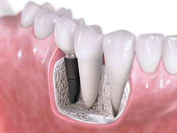  Tooth human implant. Dental concept. Human teeth or dentures. 3d illustration