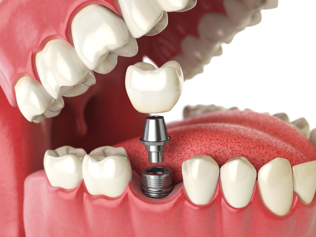 Tooth implant. Dental concept. Human teeth or dentures.